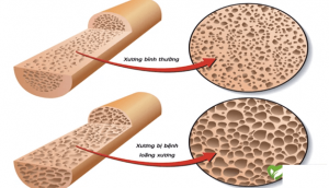 Bệnh loãng xương
