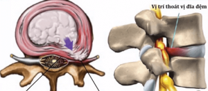 Các dây thần kinh cổ bị chèn ép