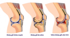Gối bị viêm