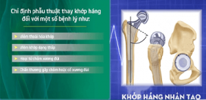 Thay thế khớp háng