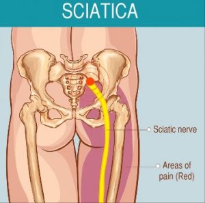 Bệnh lí đau dây thần kinh toại