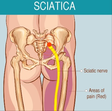 Bệnh lí đau dây thần kinh toại