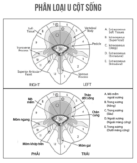 Phân loại u cột sống