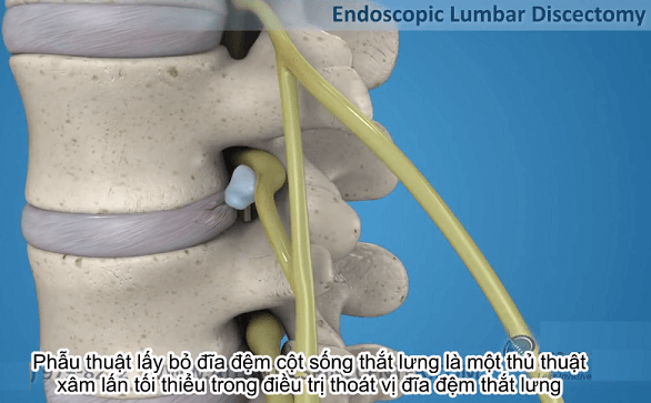 Phẫu thuật thoát vị đĩa đệm cột sống