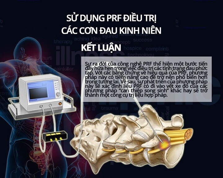 Phương pháp PRF trị đau mãn tính