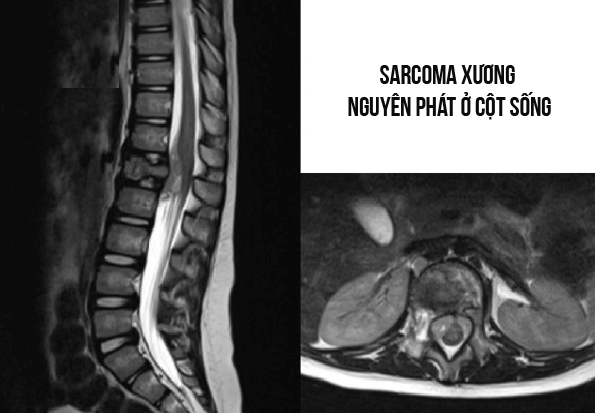 Nguyên nhân dẫn đến sacoma