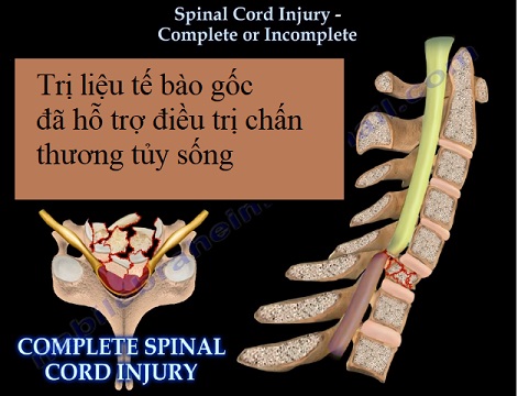 Tế bào gốc trong trị chấn thương tủy