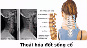 Thoái hóa đốt sống cổ
