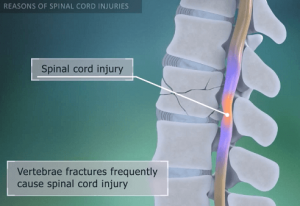 Tủy sống bị tổn thương