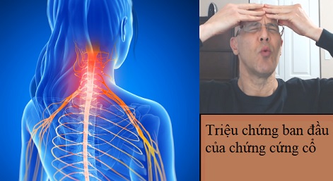 Triệu chứng đau cứng cổ