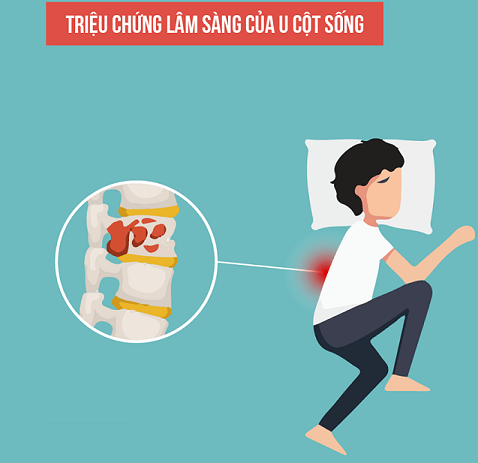 Biểu hiện lâm sàng đau cột sống