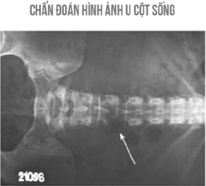 Chuẩn đoán u cột sống