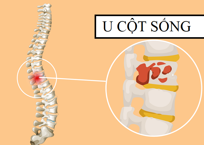 Các khối u cột sống