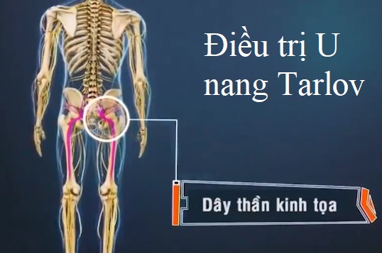 Điều trị u nang Talov